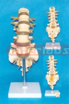 BIG LUMBAR VERTEBRAE WITH HERNIATED DISANO SACRUM & COCCYX, OPENED AND SEEN COCCYX NERVE BRANCHES, WITH STAND SIZE : 30 x 12 x 10 cm